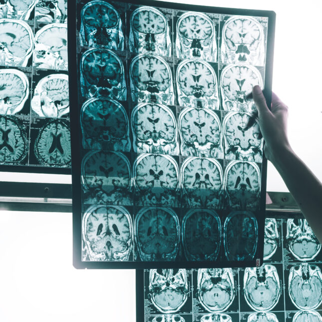 A person raises a an MRI film showing 20 frames of brain with Alzheimer's disease — first opinion coverage from STAT