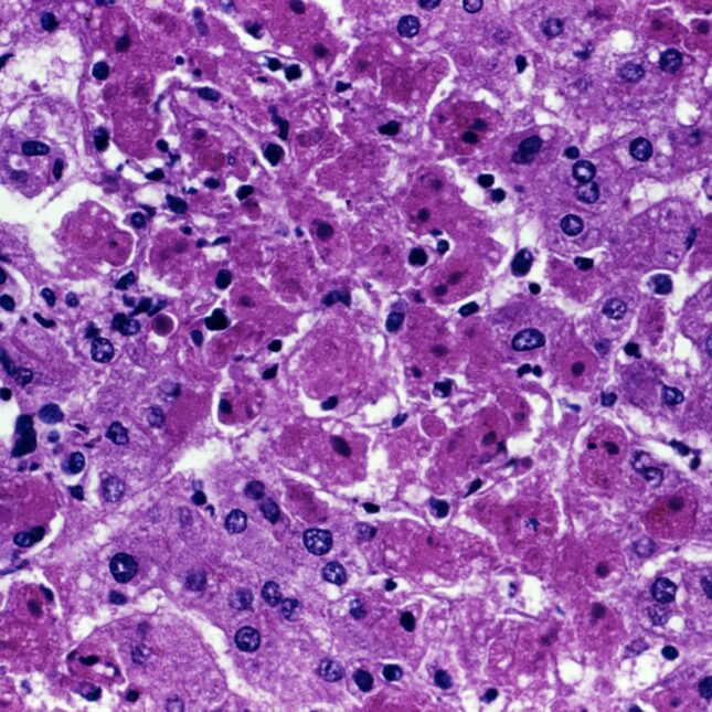 Micrograph shows a liver sample from a Marburg patient in shades of purple. -- Infectious Disease coverage from STAT.